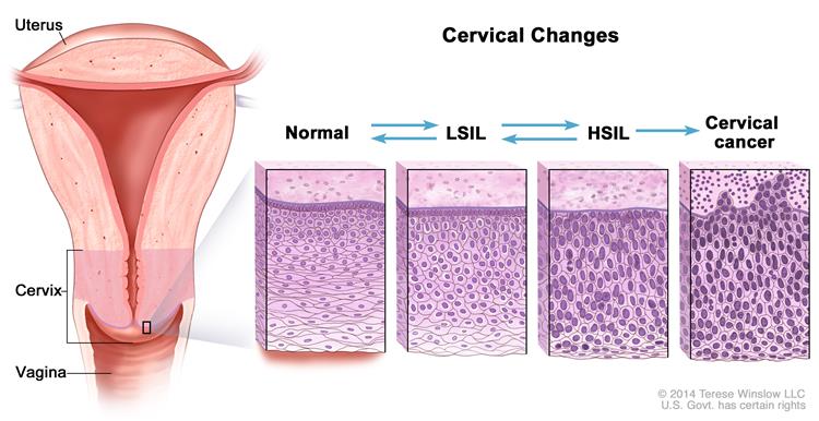 Cervix and vagina squamous cells