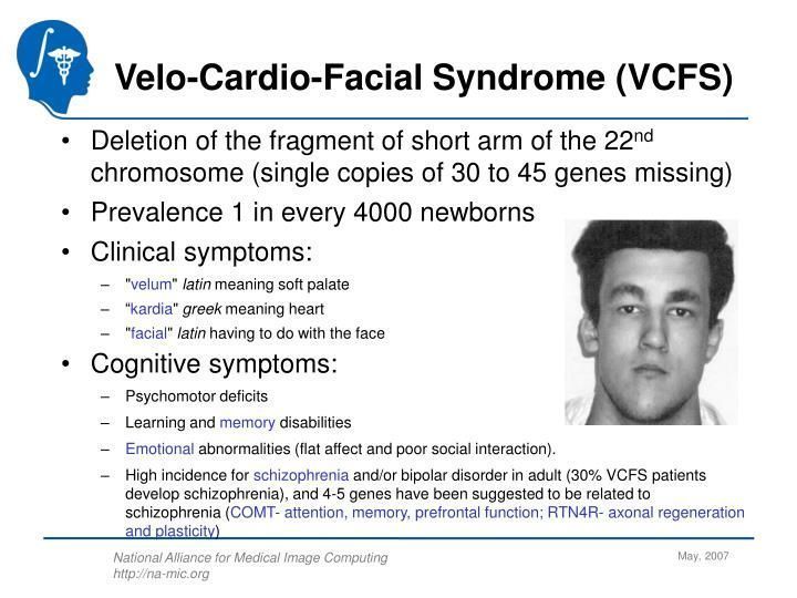 best of Velo syndrome Cardio facial