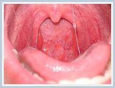Adult sore throat and adenoids