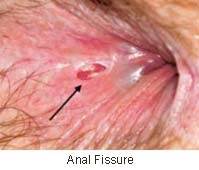 Photos of herpes around anus