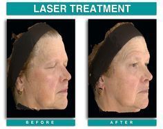 best of Redness Treating facial