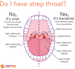 Strep throat symptoms in adults