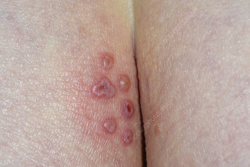 Photos of herpes around anus