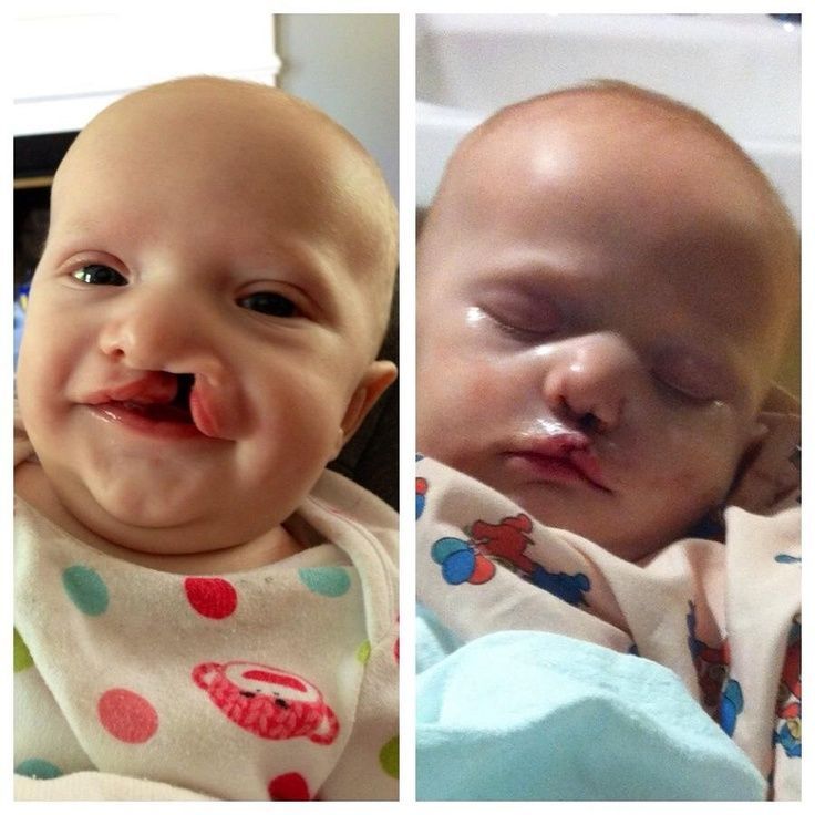 Cleft palate elicit suck post surgery