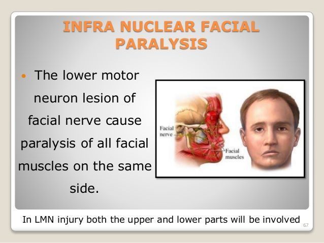 Winter reccomend Lower motor nuclear facial palsy