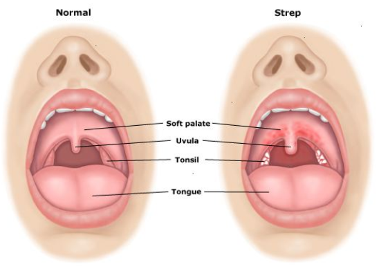 SвЂ™Mores reccomend Strep throat symptoms in adults