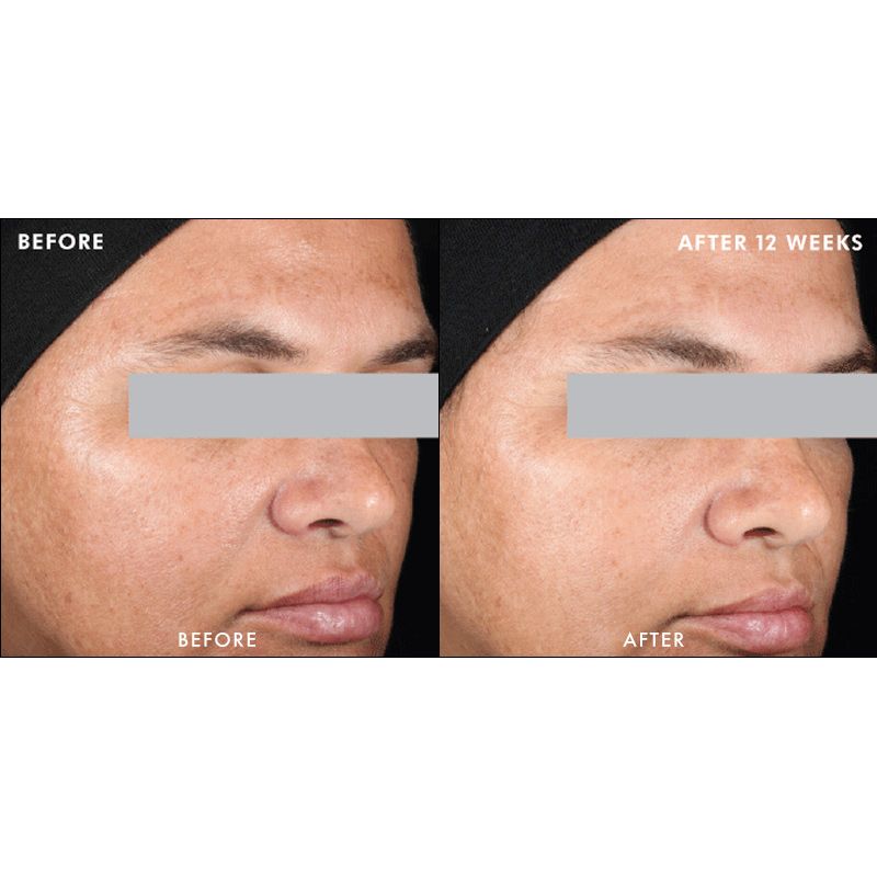 Blog about facial discoloration