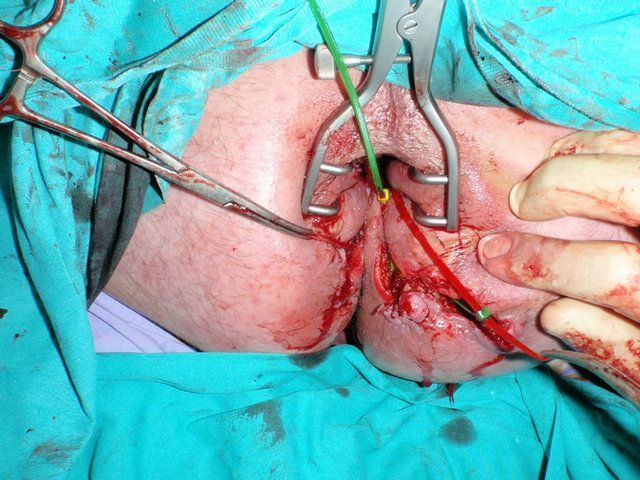 Anal fistula operation