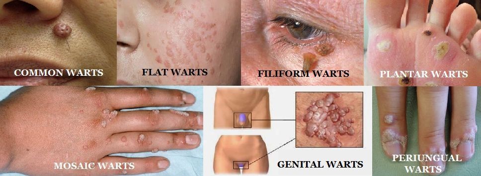 Treating facial viral warts