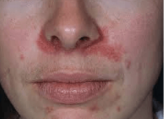 Kevorkian reccomend Itchy rash around nose anus