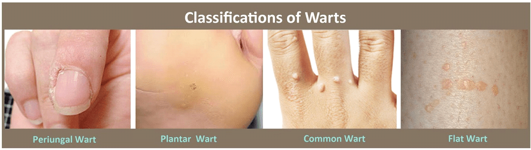 Specter reccomend Treating facial viral warts