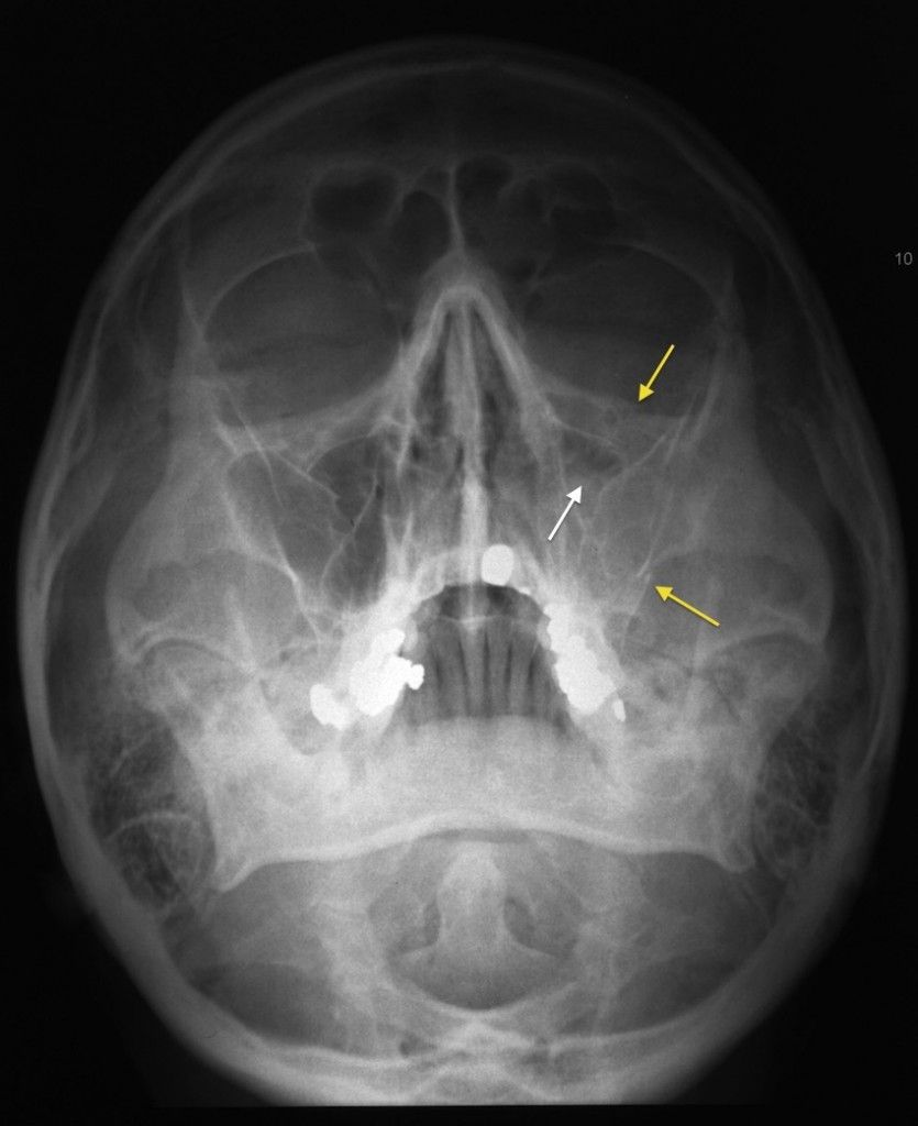 Facial fracture x-ray