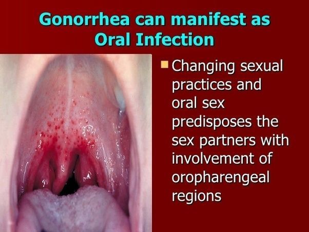 best of By Getting blowjob gonorrhea a