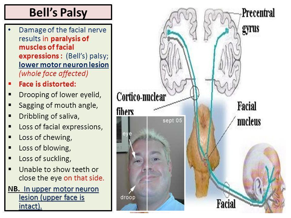 Lower motor nuclear facial palsy