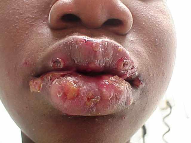 Facial herpes symptoms
