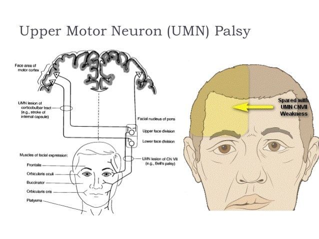 POTUS reccomend Lower motor nuclear facial palsy