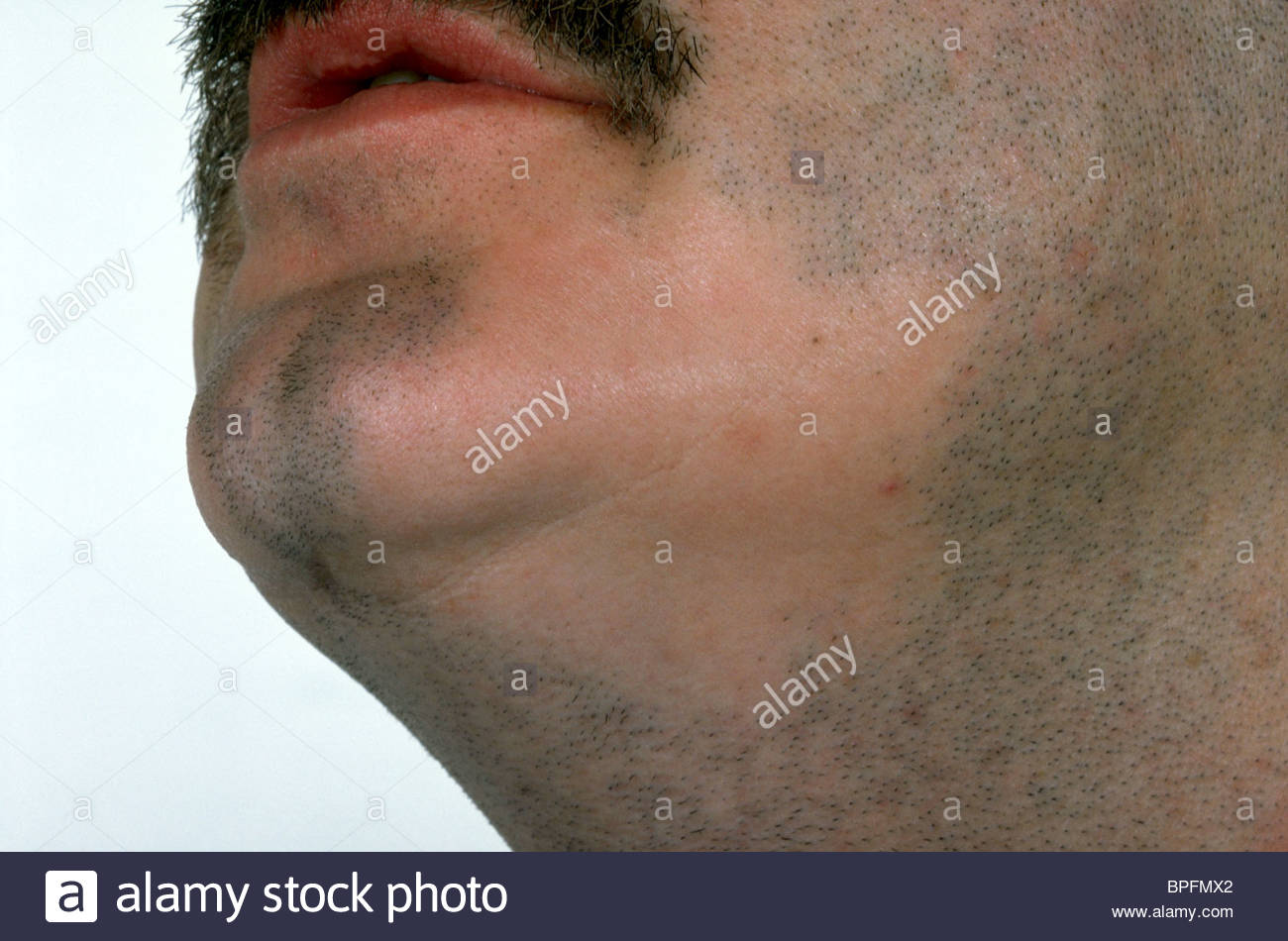Fumble reccomend Facial alopecia areata