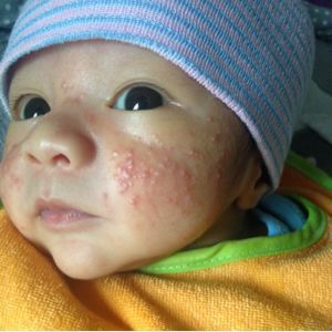 Black M. reccomend Acne infant treatment acne scarring facial cleanser