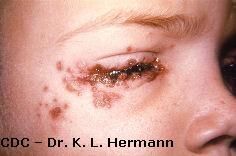 Half-Pipe reccomend Facial herpes symptoms