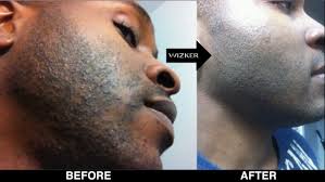 Black men facial hair bumps