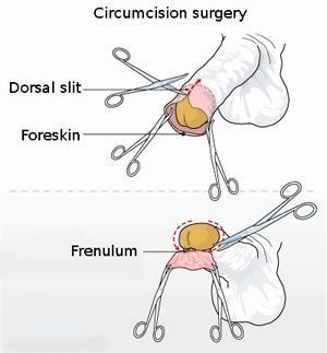Athens reccomend Clit hood circumcision
