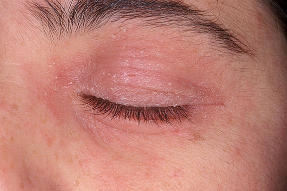 Eye lid facial skin rashes