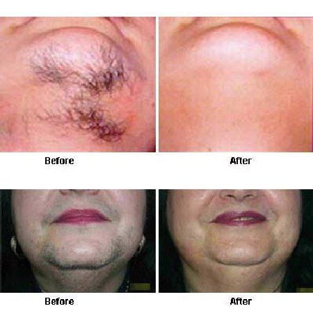 best of Hair facial Remove coarse