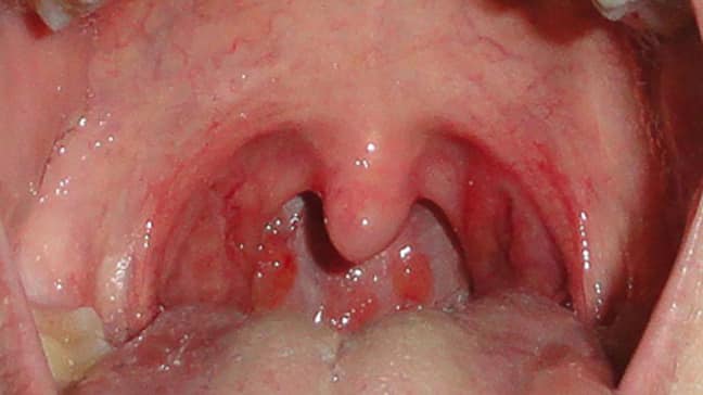 PB&J reccomend Strep throat symptoms in adults