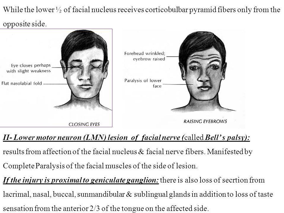 best of Nuclear Lower facial palsy motor