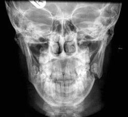 best of X-ray Facial fracture