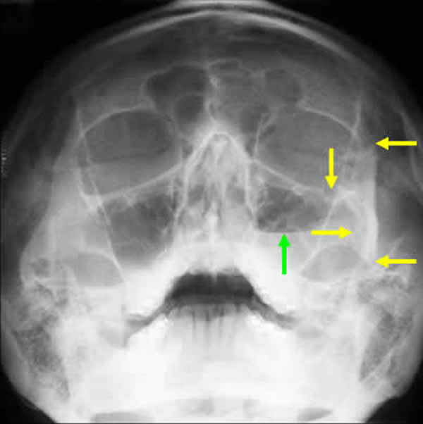 Moonstone reccomend Facial fracture x-ray