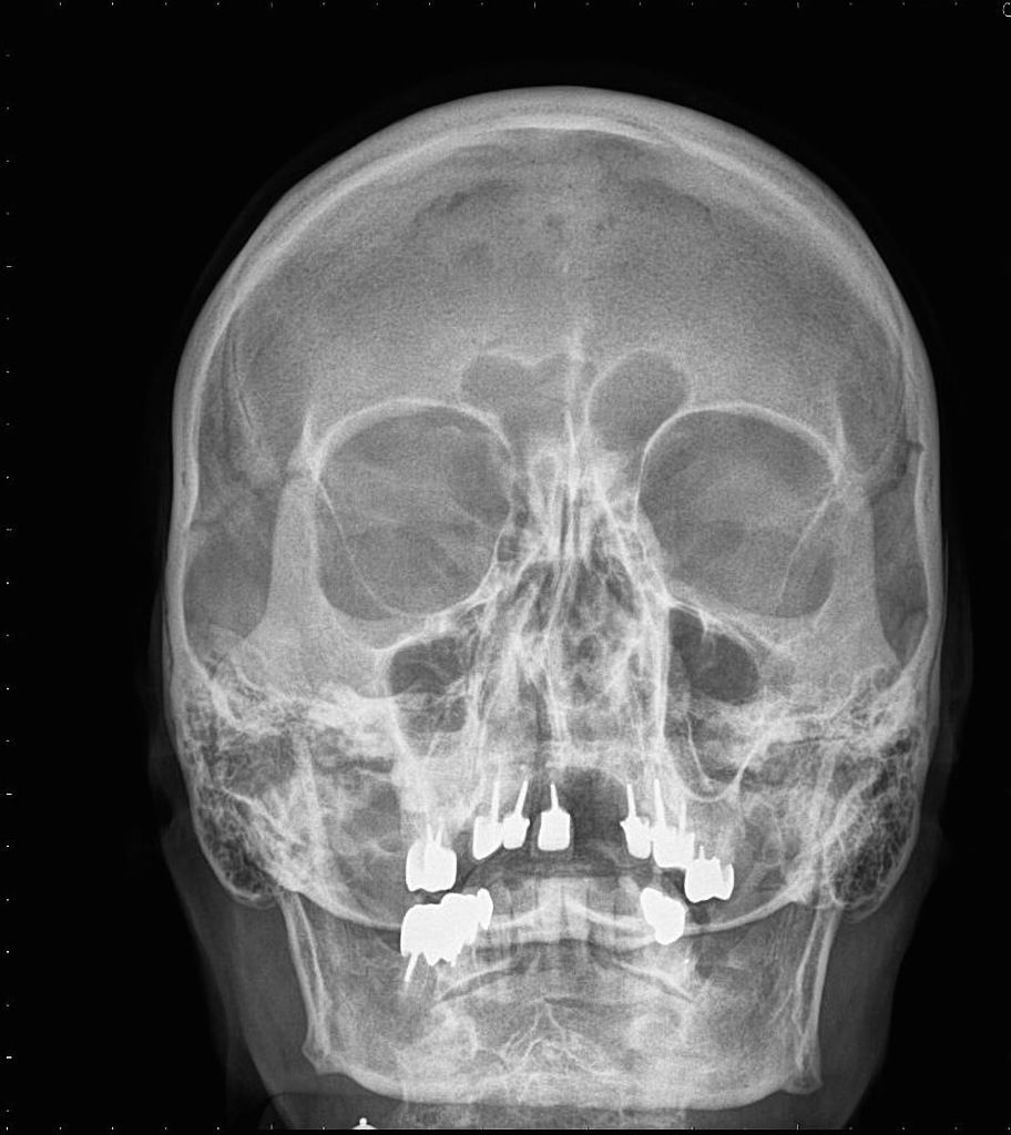 Iron reccomend Facial fracture x-ray