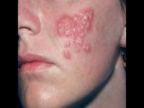 best of Symptoms Facial herpes