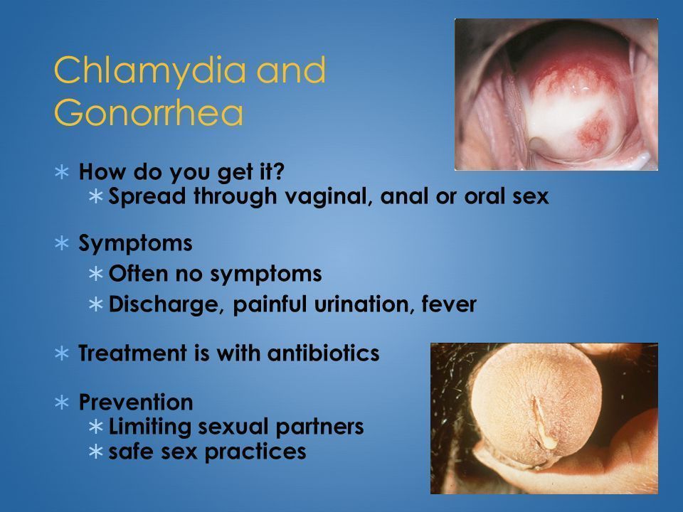 Getting gonorrhea by a blowjob