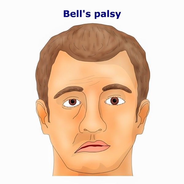 Lower motor nuclear facial palsy