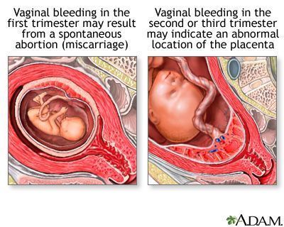 Boomstick reccomend Pregnancy bleeding after sex